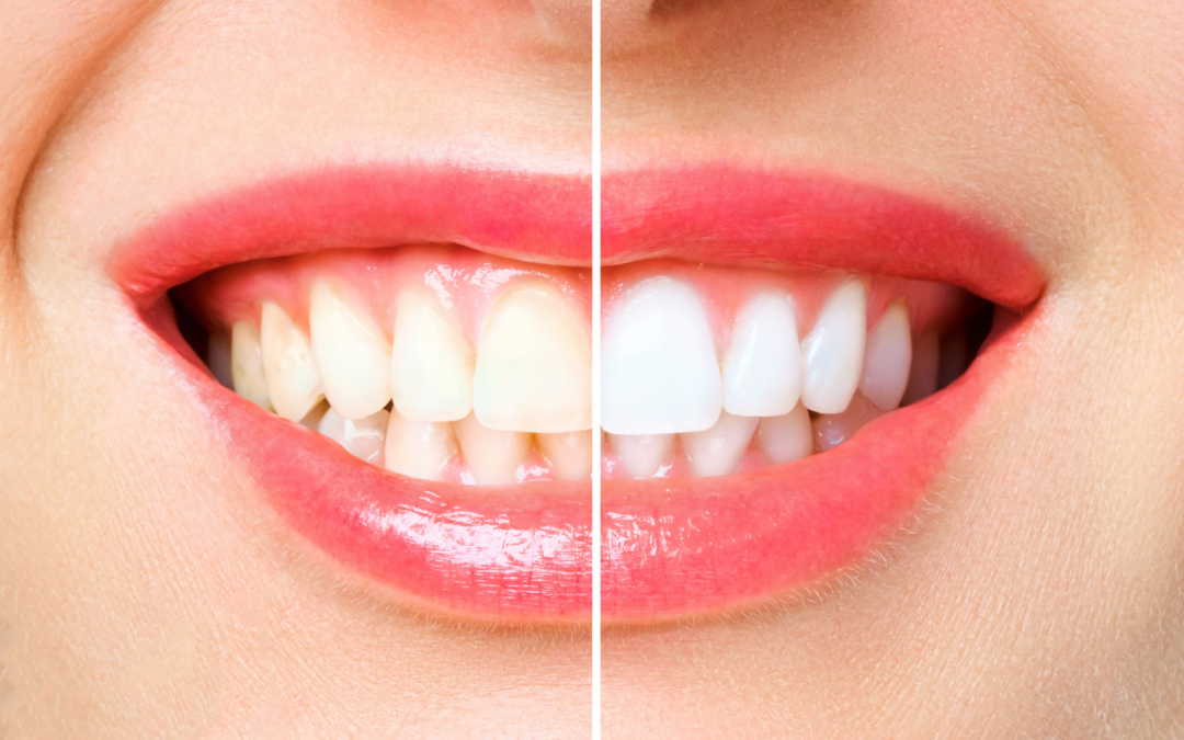 Teeth Whitening: How We Can Brighten Your Smile