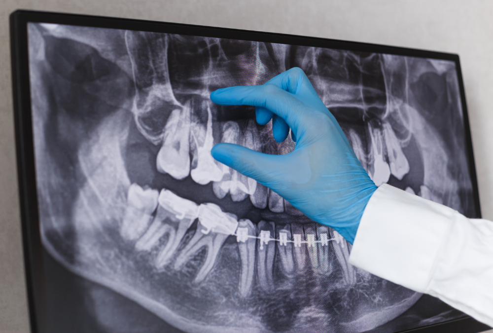 Understanding The Process Of A Root Canal