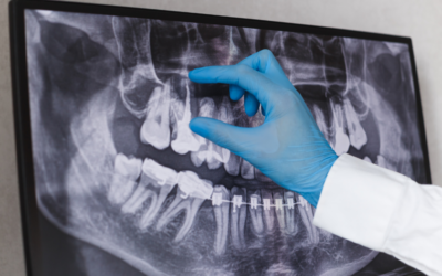 Understanding The Process Of A Root Canal